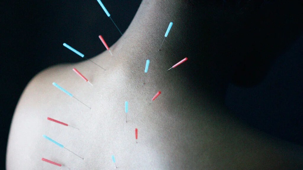 Acupuncture The Art and Science of Body Stimulation